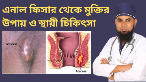 এনাল ফিসার থেকে মুক্তির উপায় ও স্থায়ী চিকিৎসা