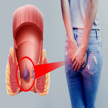 Piles treatment Dr Faridul Islam