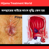 মলদ্বারের বাইরে মাংস বৃদ্ধি কেন হয় বায়ু পথে কি কি কারণে সমস্যা হয়