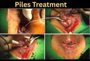 Piles Symptoms