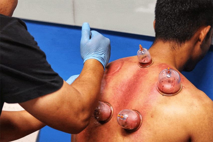 Piles Cupping Therapy