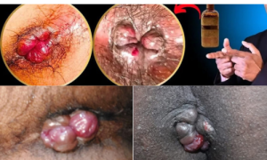 Best Piles Treatment BD