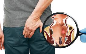 Symptoms of PilesTreatment