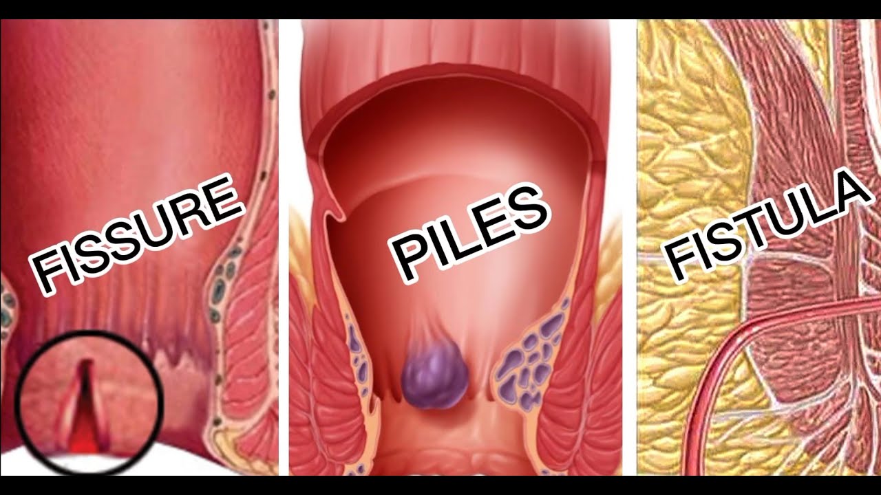 Fistula Treatment