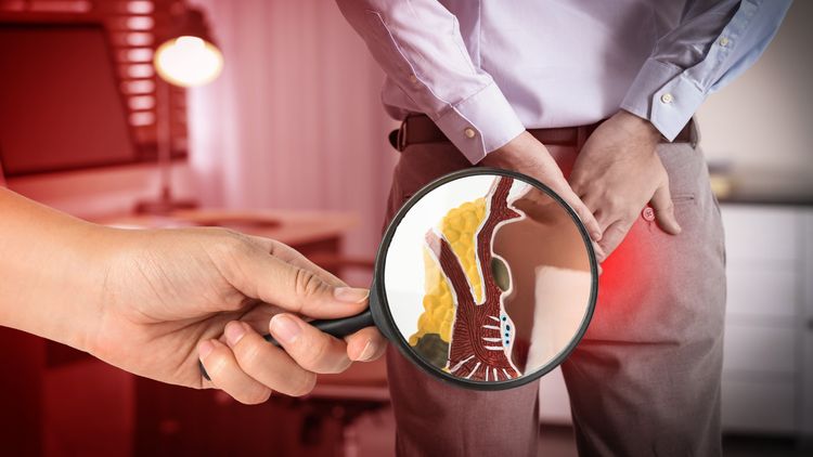 অপারেশন ছাড়া Piles স্থায়ী চিকিৎসা