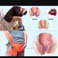 Piles Treatment Bangladesh