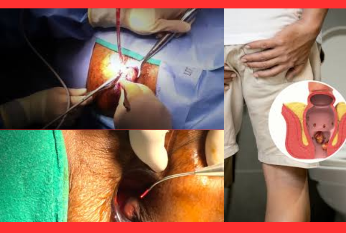 মলদ্বারে মাংস বৃদ্ধি হলে করণীয় কী